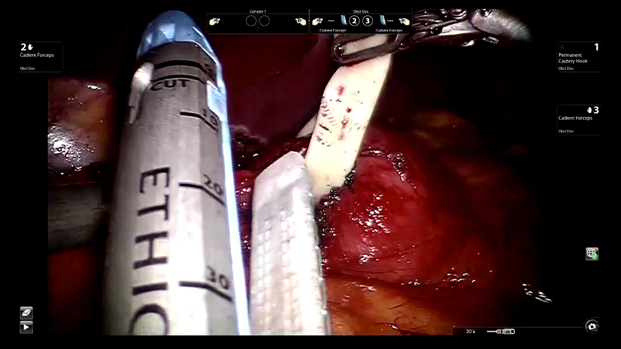 Duodenal Switch Completely Robotic