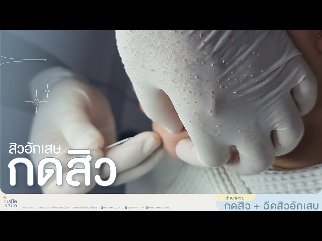 กดสิว EP.373/เก็บสิวให้นุ่มนวล รอยช้ำรอย ดำน้อยลง แค่นี้ผิวก็ปังขึ้นแล้ว ✨ @หมอปุ๊ NeramitClinic