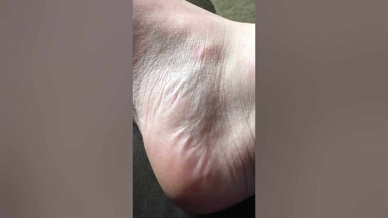 bfs-right-foot-twitching-involuntary-muscles-youtube