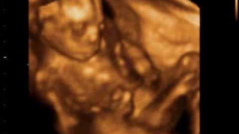 4D Ultrasound at 17 weeks by 1st Glimpse Inc.