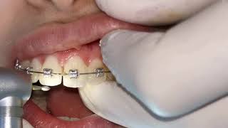 teeth gaps, Black triangle treatment with braces