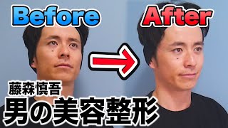 男のガチ美容　リフトアップしてみた【美容整形】