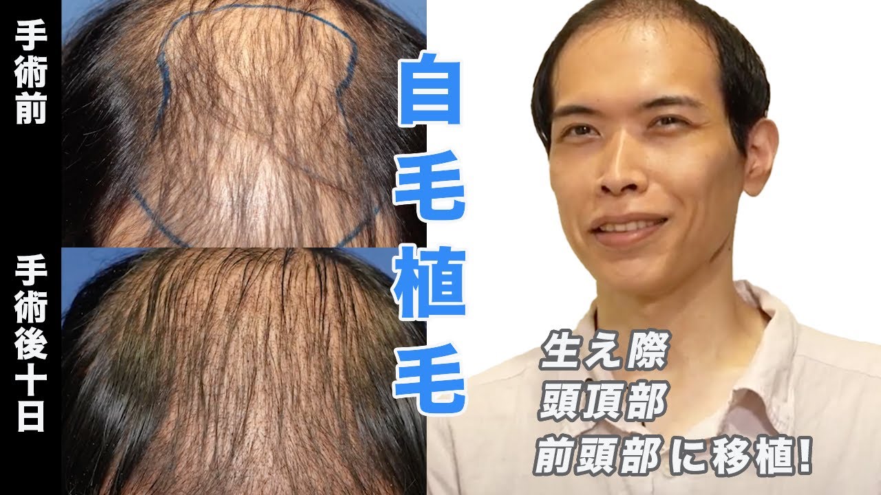 Dr.今川の植毛体験記 専門医が自分の髪で実践したドキュメント