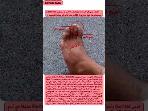 أصبع قدم مورتون    لماذا أصبع القدم الثاني أطول من بقية الأصابع  