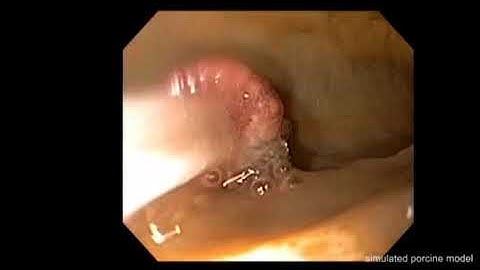 ROTH NET™ Platinum™ Retriever - Polyp Retrieval