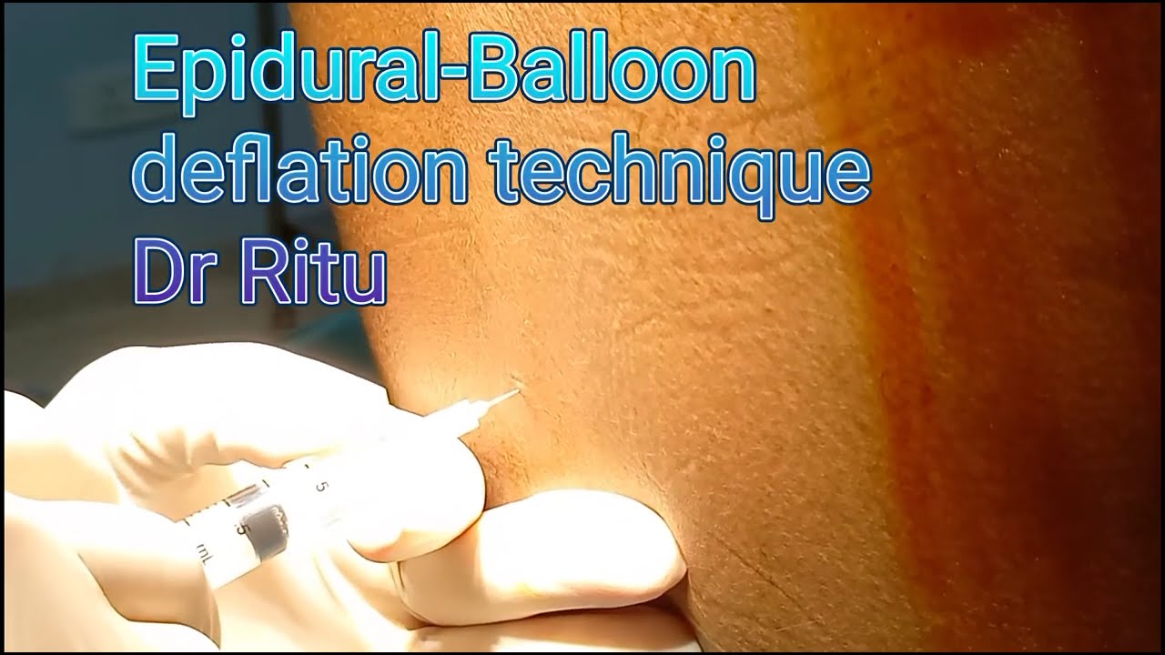 EpiduralBalloon deflation technique YouTube