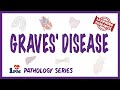 Graves Disease - Pathophysiology, Symptoms, Diagnosis, Treatment