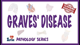Graves Disease - Pathophysiology, Symptoms, Diagnosis, Treatment