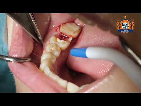 Simple Easy Effecint Extraction Technique طریقه ساده و آسان کشیدن دندان