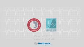 Medtronic ICD | 3. Therapies | VF ATP 3