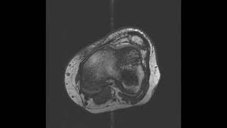 Chronic patella dislocation MRI axial