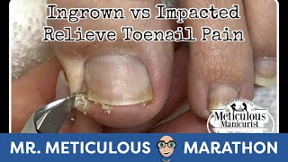 👣Ingrown Toenail and Impacted Toenail Relief and Prevention👣#MrMeticulousMarathon