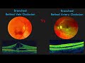 Branch Retinal Vein Occlusion BRVO FUNDUS And OCT Findings Branch Retinal Vein Occlusion BRVO FUNDUS And OCT Findings