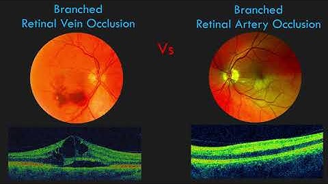 Branch Retinal Vein Occlusion (BRVO) - FUNDUS and OCT Findings