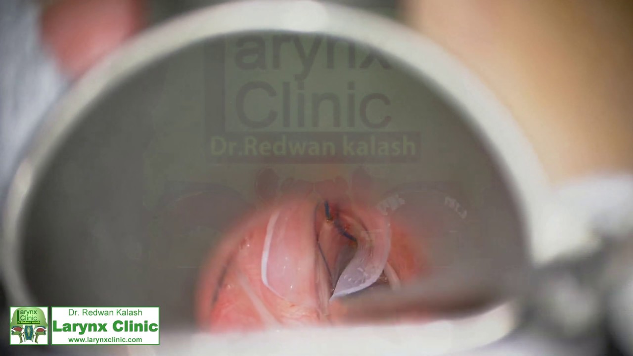 Laryngeal web surgical correction