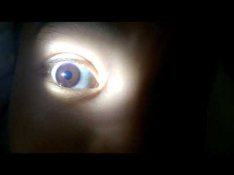 Iris Shadow test pada orang normal - pemeriksaan katarak