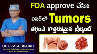 Histotripsy new method of treatment approved by FDA for liver tumors | Tumor treatment I Dr Subbaiah