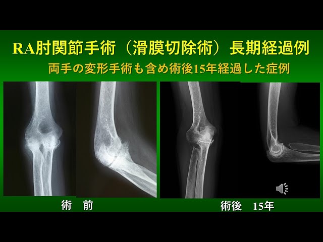 肘関節手術のすべて メジカルビュー社｜整形外科｜肘関節手術のすべて