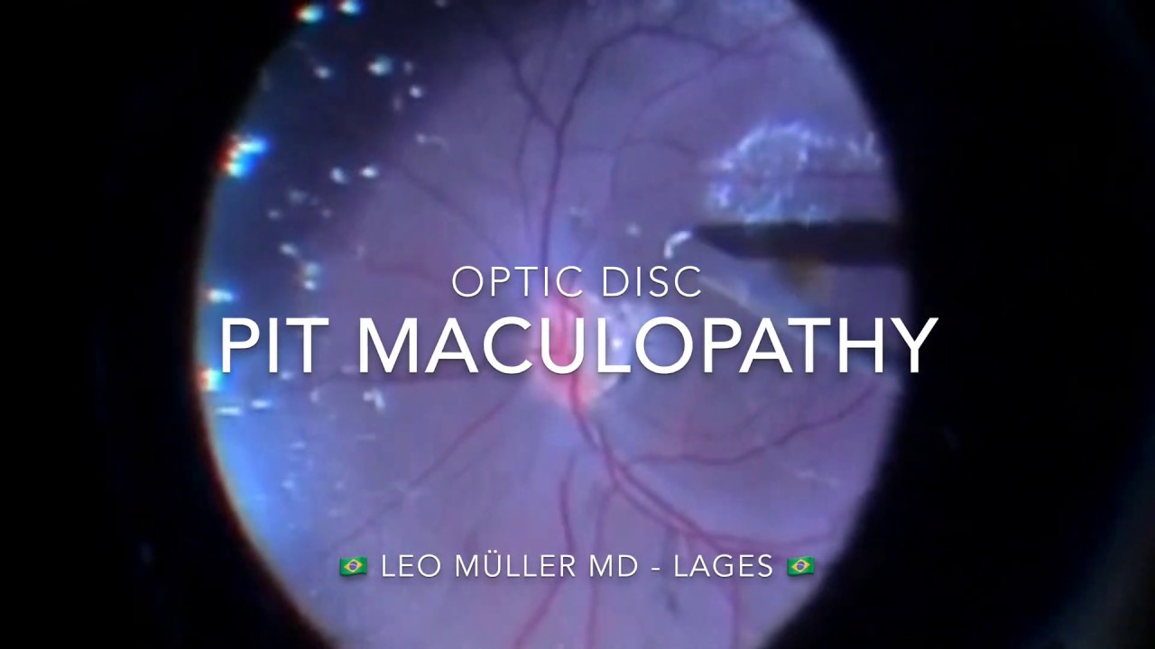 Optic disc pit maculopathy Author Leo Müller MD YouTube