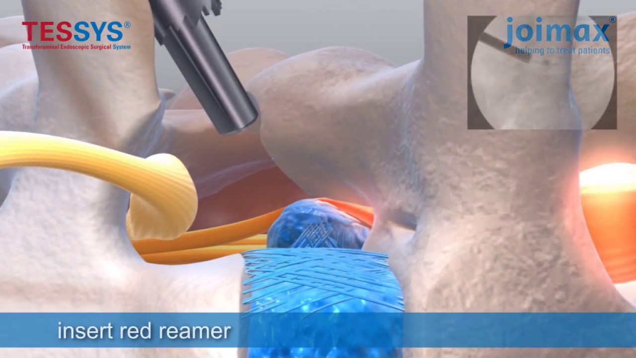 Эндоскопическое удаление грыжи диска