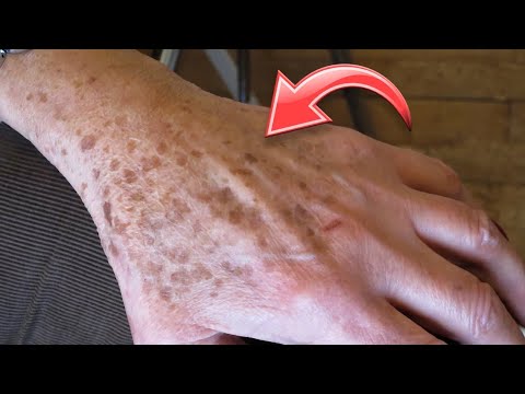 Video: So entfernen Sie Flecken von Ihren Händen