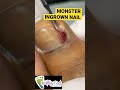 MONSTER INGROWN NAIL #shorts