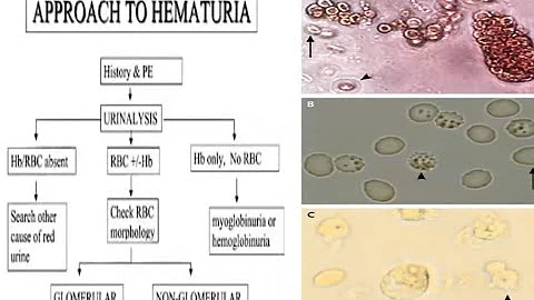 Approach to Hematuria- PG Seminar Dr Sameeksha Mod...