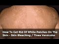 How To Get Rid Of White Patches On The Skin - Skin Bleaching Spots & Tinea Versicolor