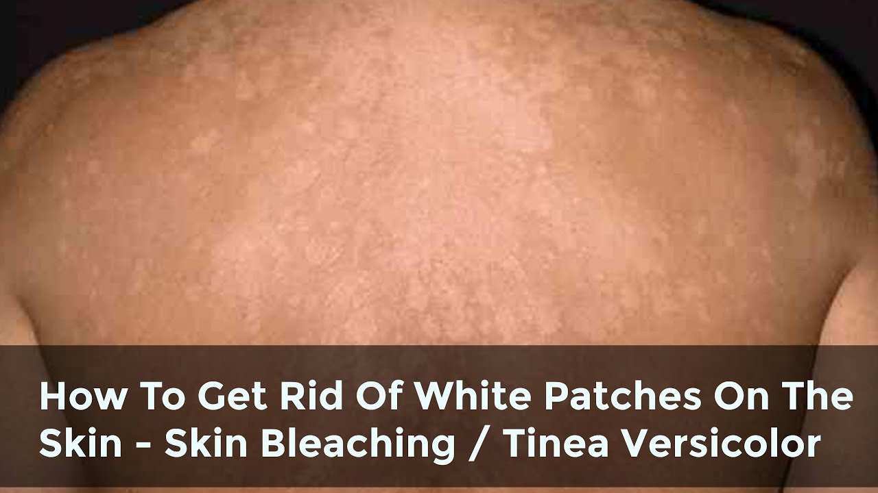 How To Get Rid Of White Patches On The Skin Skin Bleaching Spots