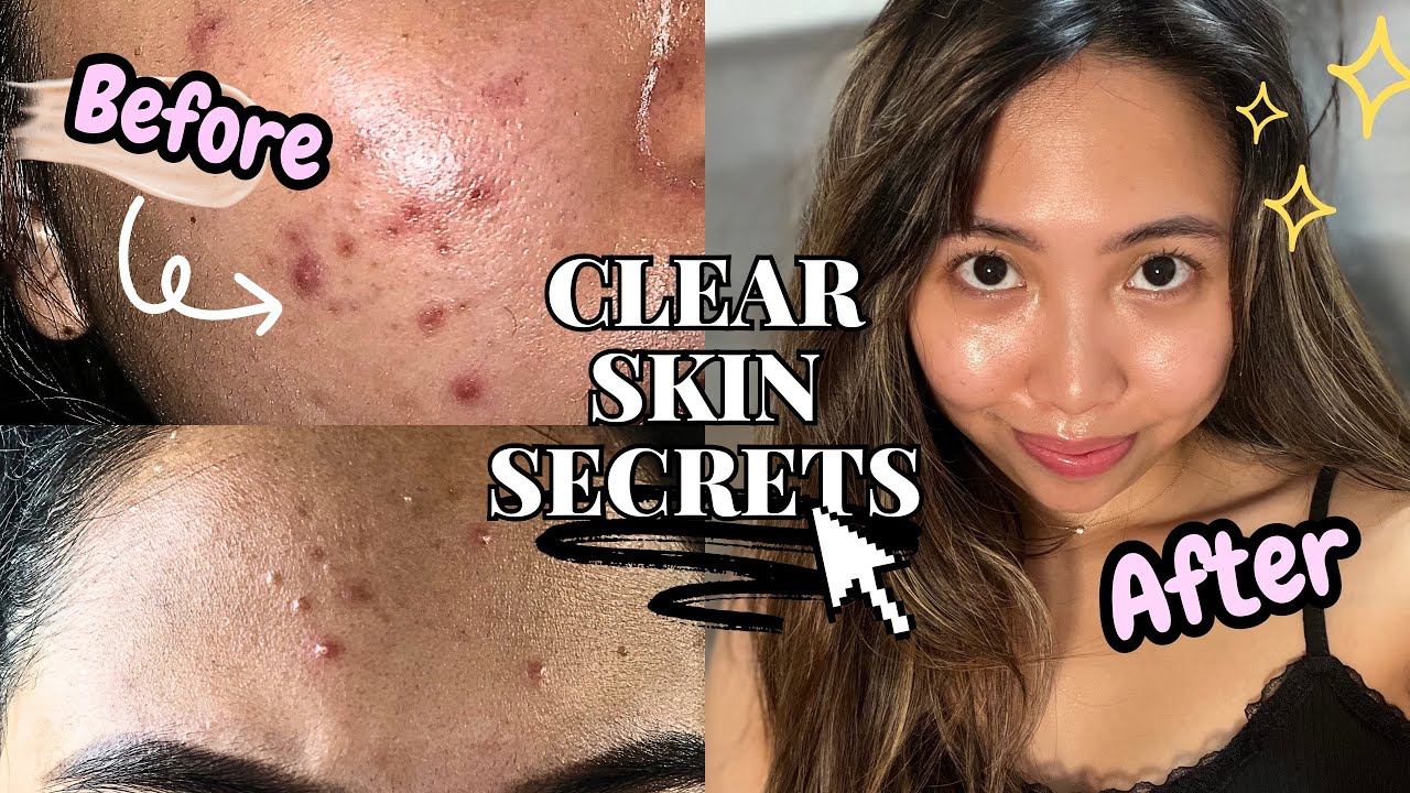 My Skincare Routine that Finally Cleared My Acne Fast with No ...