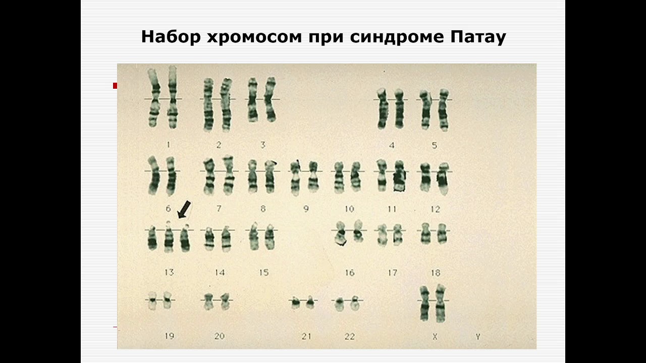 Появление в генотипе лишней хромосомы