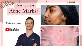 Acne Marks treatment at home | Acne treatment Dermatologist | Lasers and peels | Dr. Ankur