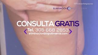 Especialista Retiro De Biopolimeros En Gluteos, Cara, Labios I Doctor Antun I Miami, Florida