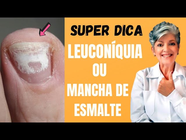 Manchas Brancas Nas Unhas Dos Pes Apos Remover O Esmalte