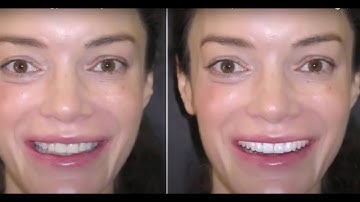 Bioclear Uveneer Smile Makeover: Choosing Your Shade Is Important For Satisfaction | Part 4