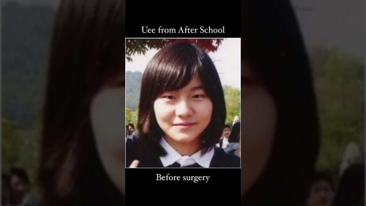Before And After Surgery Of Uee From AfterSchool Kpop Plasticsurgery Fyp