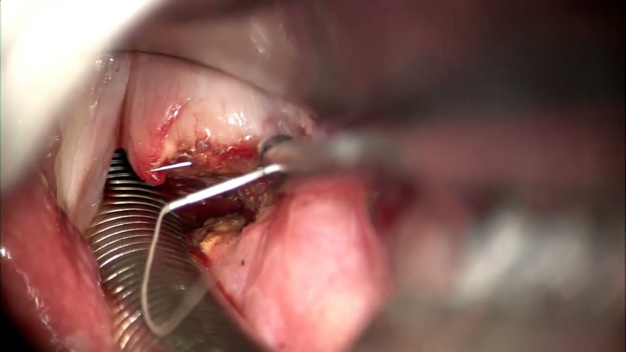 Submucosal cordetomy anterior flap using Blue laser
