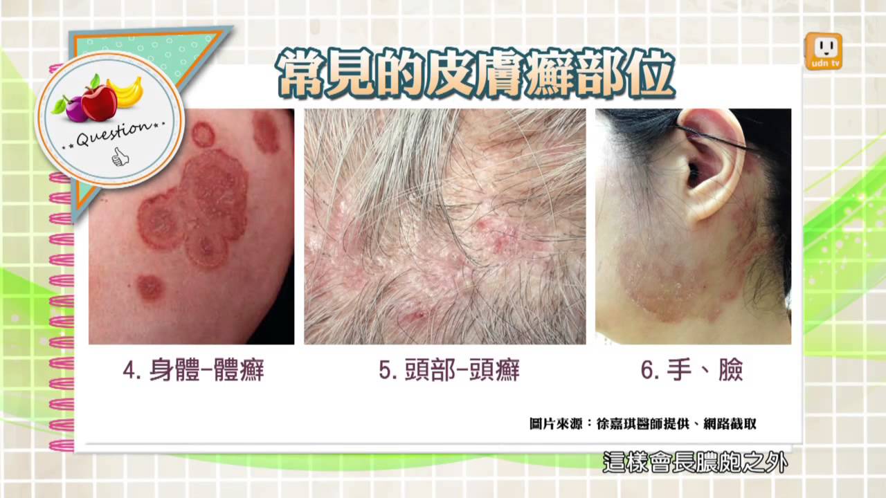 股癬 _ いんきんたむし 症状 写真 – やさしくわかる病気事典: 股部白癬 – QTUL