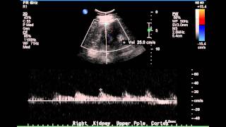 Duplex Demonstration of Normal Renal Arterial Blood Flow - Case Study