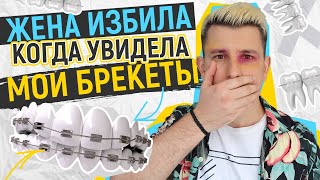 Мне поставили брекеты! Первые ощущения и проблемы с брекетами