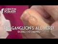 The Ganglion’s All Here! Double Cyst Draining