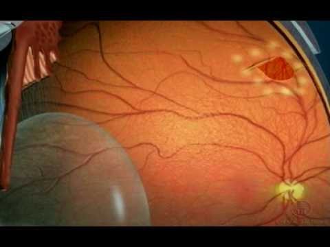 Vídeo: Coagulação retiniana a laser