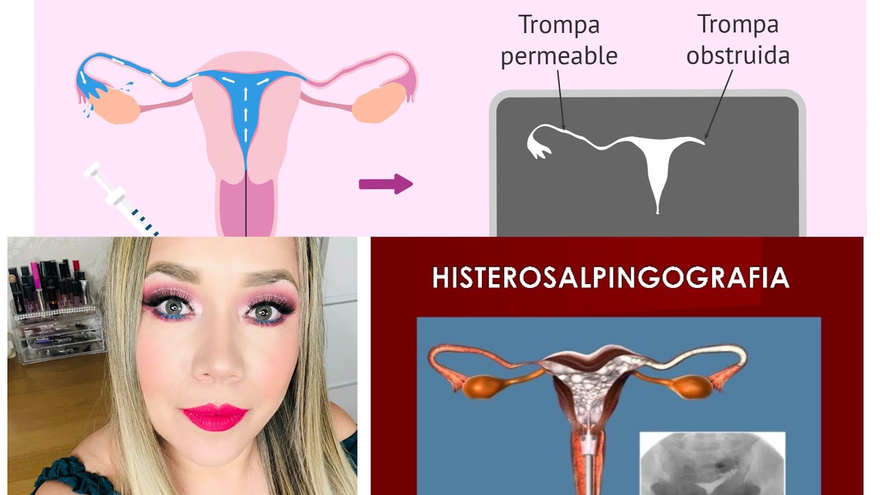 Histerosalpingografia/trompas obtruidas, bloqueadas/tiene solucion mi experiencia YouTube Histerosalpingografia/trompas obtruidas, bloqueadas/tiene solucion mi experiencia YouTube