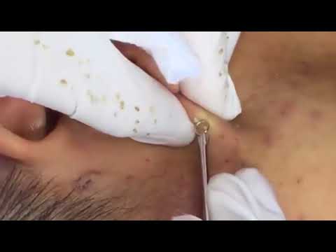 (AMAZING) !!! BEST BLACKHEAD REMOVE AND CYSTIC  REMOVE ON FACE (PART )