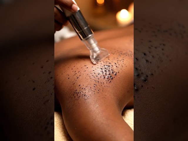 Satisfying Blackhead Extraction You Can’t Skip 😵