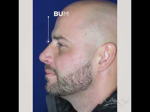 Video thumbnail: Rhinoplasty Testimonial Post Op: "I Still Look Like Myself" · Dr. Anthony Corrado
