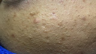 Acne Treament Under The Skin #068