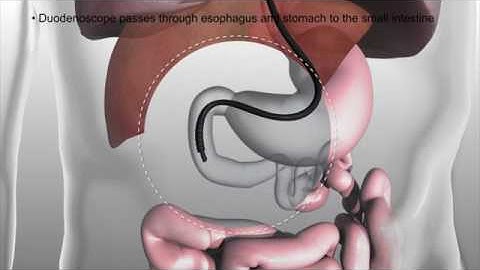 SpyGlass™ DS Direct Visualization System   USA