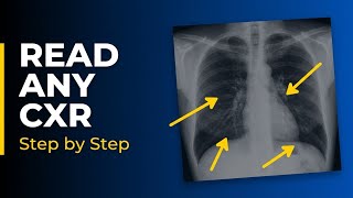 How to Read a Chest X-Ray: Step by Step for Beginners 