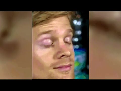 sf-man-behind-viral-'blinking-guy'-gif-backs-multiple-sclerosis-fundraiser